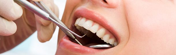 Clínica Dental Campos limpieza dental
